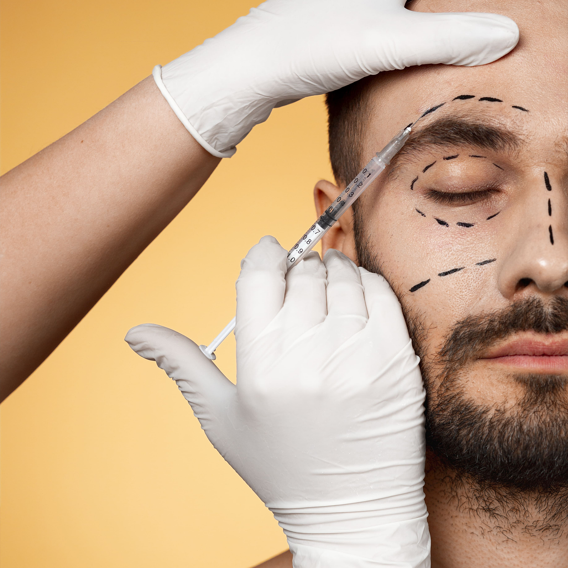 Toxina Botulínica (1 zona - 6 puntos) 1