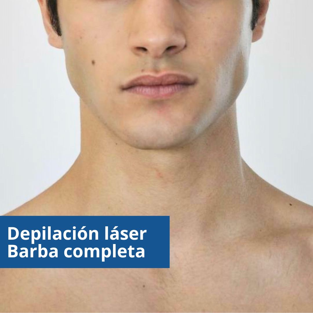 Depilación láser barba completa