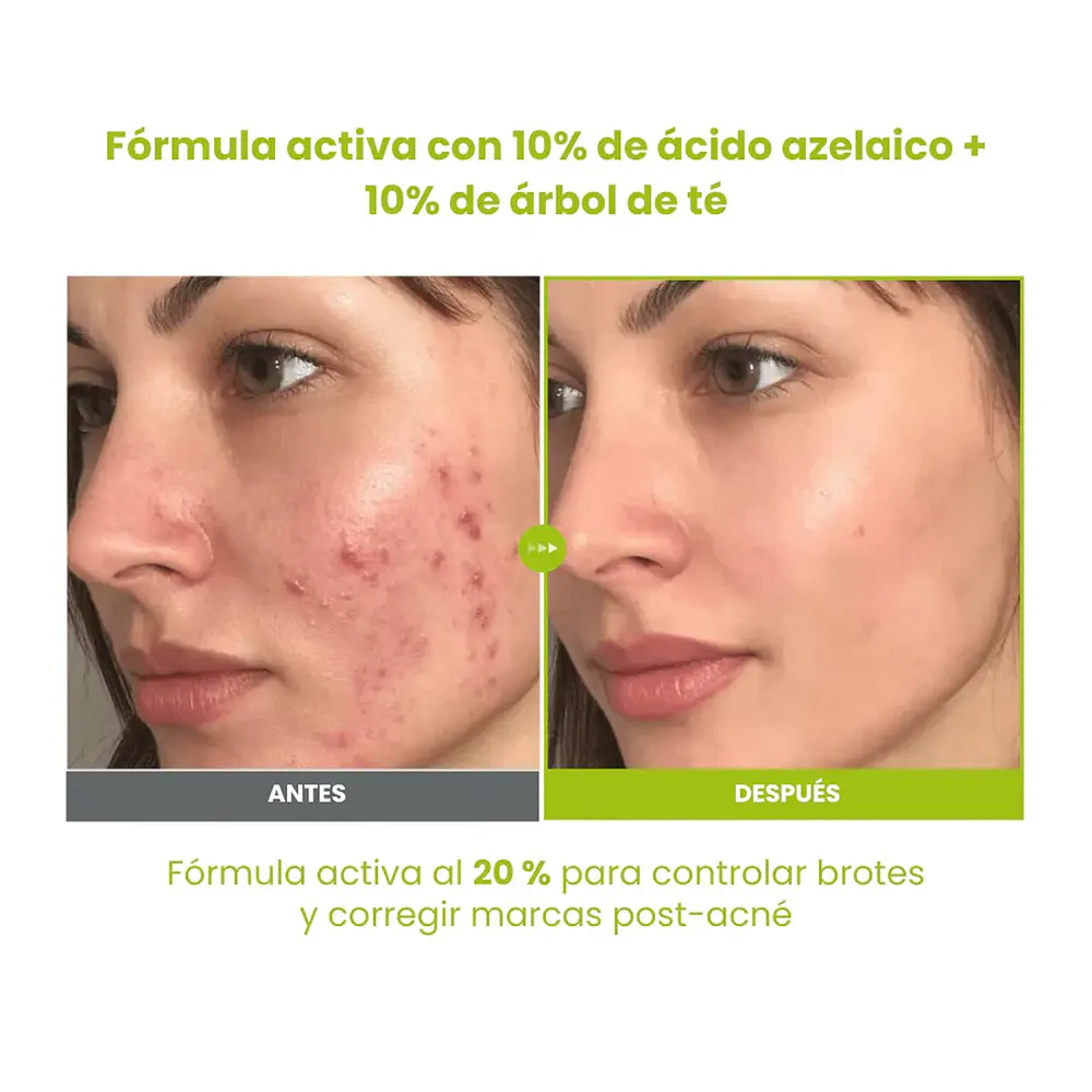 AZELAIC ACID 10 KOJIC TEA TREE