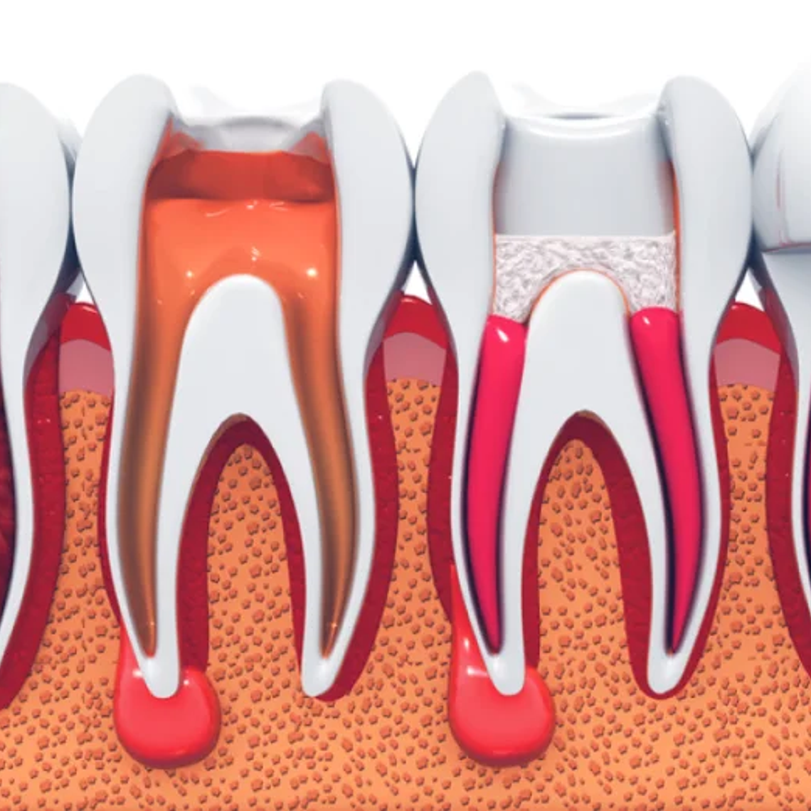 Endodoncia dental  2