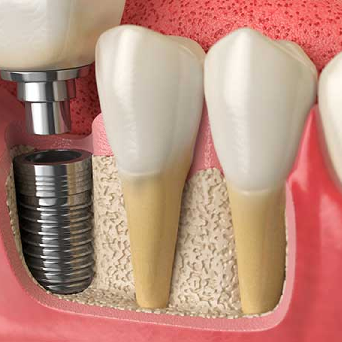 Implantes Dentales 1