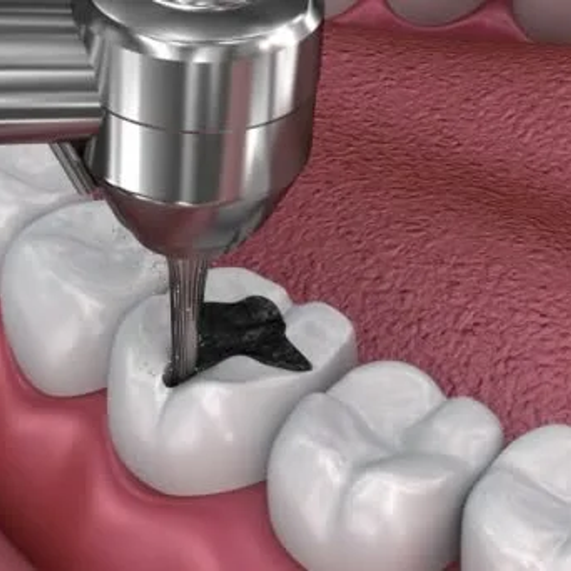 Restauración dental 1