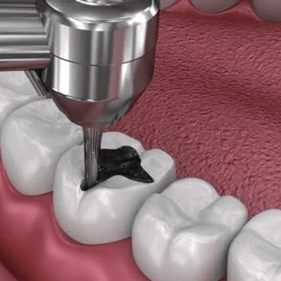 Restauración dental