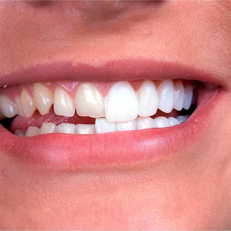 carillas dentales 1