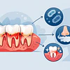 Sïntomas de enfermedad periodontal: señales clave