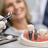 Rehabilitacion Oral con implantes: qué esperar