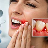 Sïntomas de enfermedad periodontal: señales clave