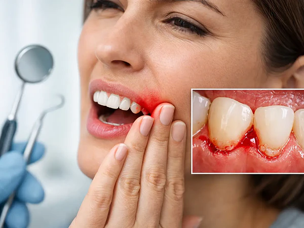 Sïntomas de enfermedad periodontal: señales clave