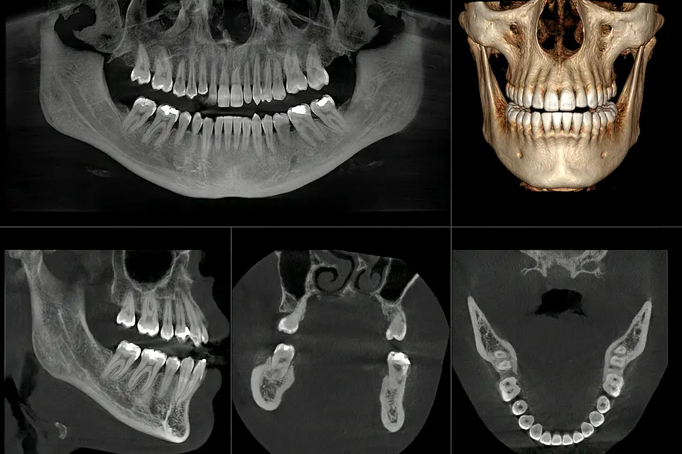 Tomografía HD para endodoncia dental 1