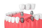 Consejos para el Cuidado de tus Implantes Dentales