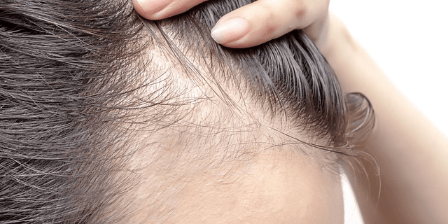 Las múltiples causas por las que puedes estar perdiendo el cabello.
