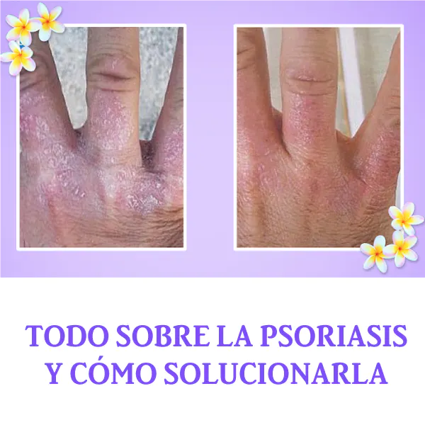 Todo sobre la Psoriasis y cómo solucionarla