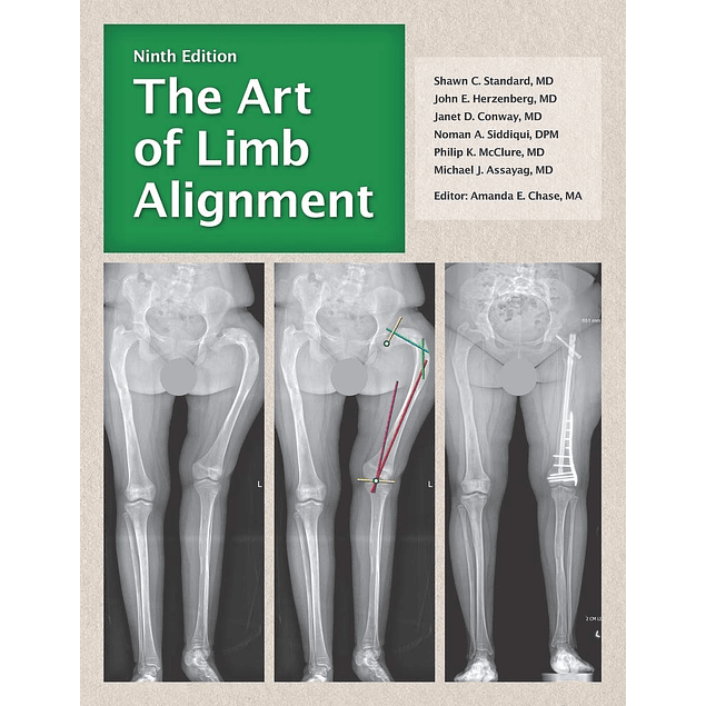 The Art of Limb Alignment