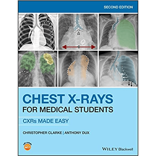 Chest X-Rays for Medical Students: CXRs Made Easy