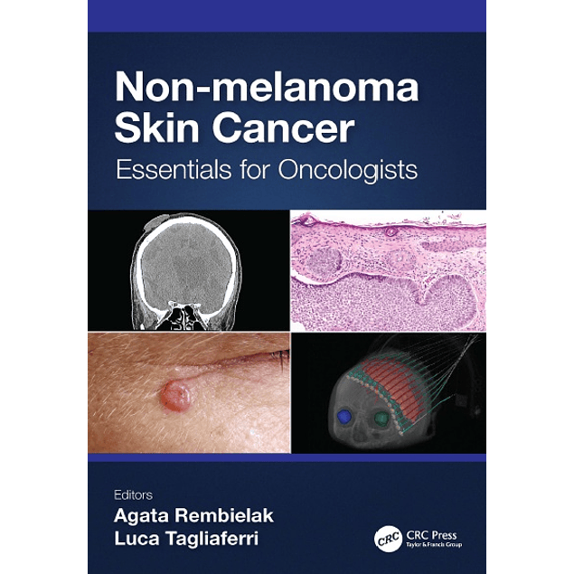 Non-melanoma Skin Cancer: Essentials for Oncologists