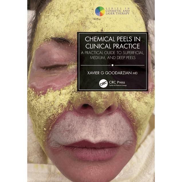 Chemical Peels in Clinical Practice: A Practical Guide to Superficial, Medium, and Deep Peels (Series in Cosmetic and Laser Therapy)