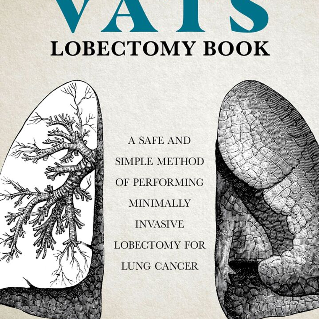 The VATS Lobectomy Book: A Safe and Simple Method of Performing Minimally Invasive Lobectomy for Lung Cancer 1