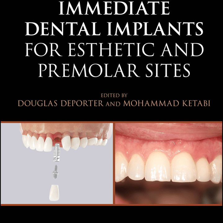 Immediate Dental Implants for Esthetic and Premolar Sites 1
