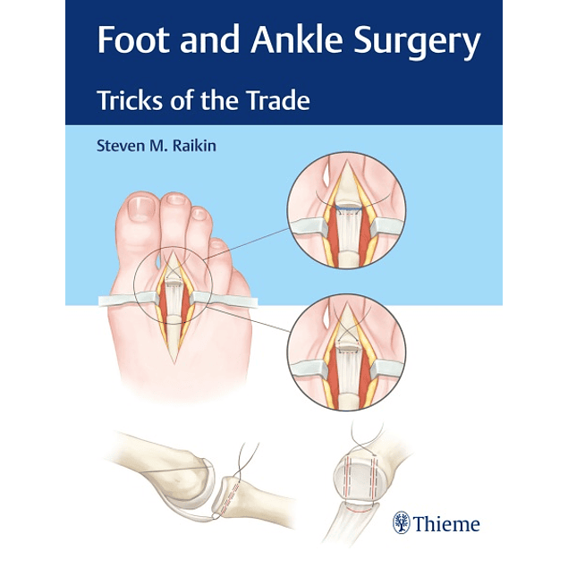 Foot and Ankle Surgery: Tricks of the Trade