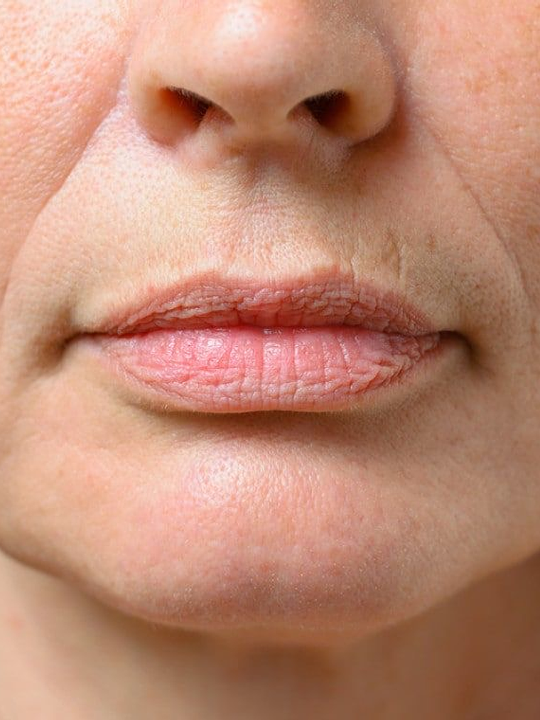 Corrección de surcos de marioneta 1