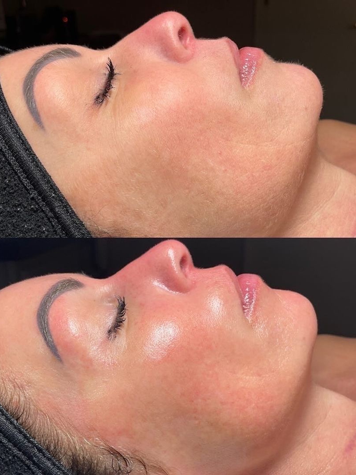 Hydrafacial MD (1 hr aprox) 2