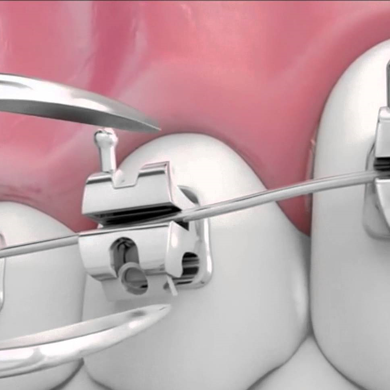 Y-Self-ligating bracket roth/0.022 345w/h 20pcs 1