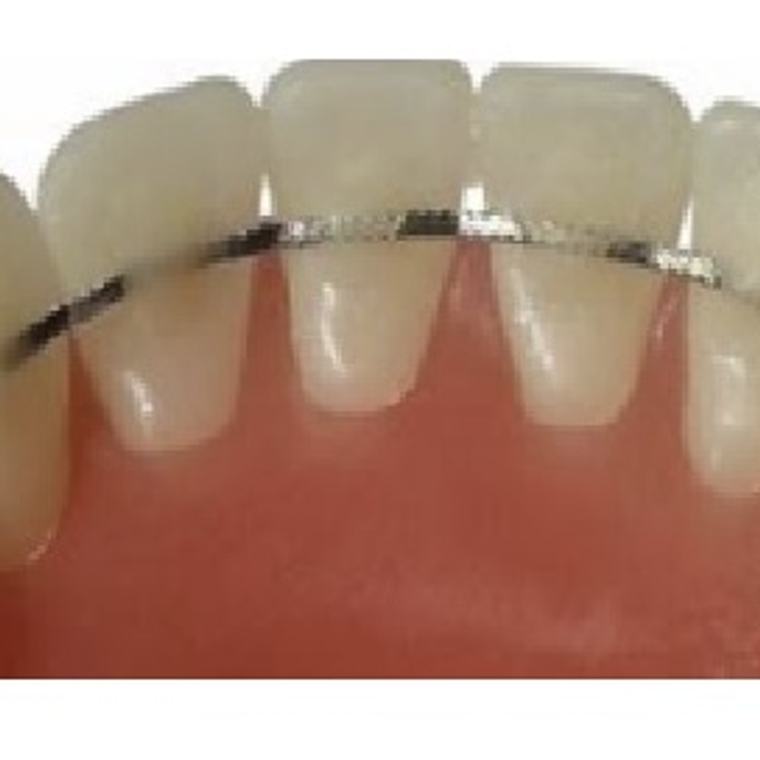 Retenedor Lingual Tipo 1 2