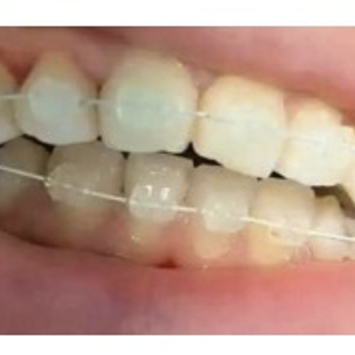 Niti Invisible Arch Wire . 3