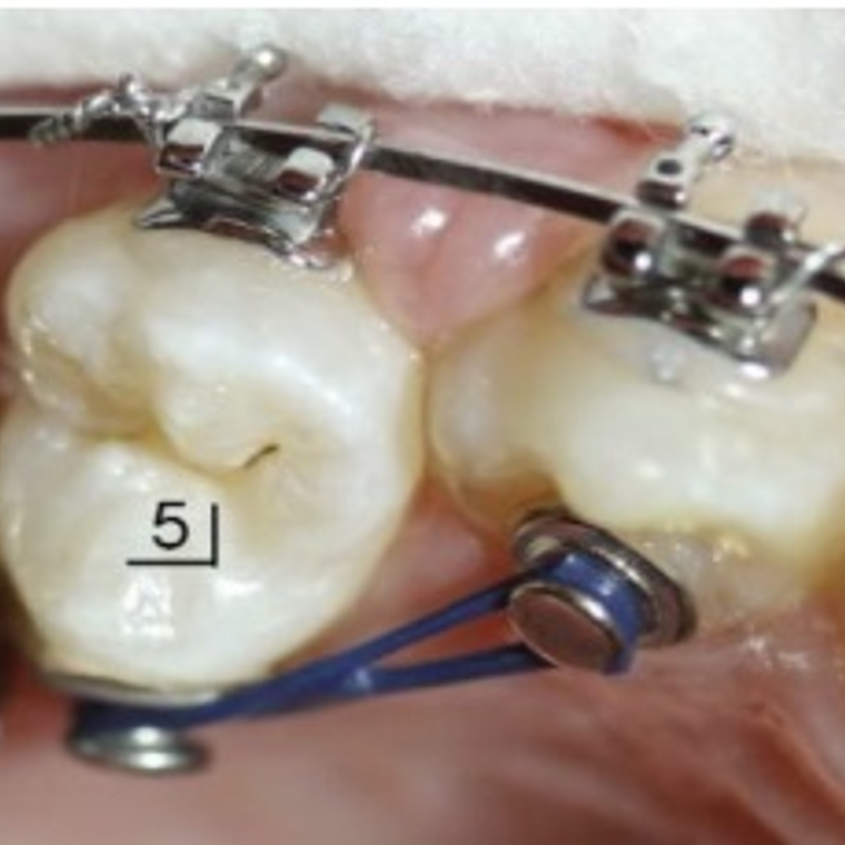 Botón Lingual Metálico - Monoblock 2