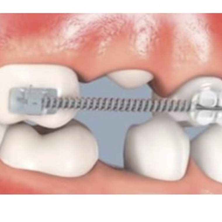 Resorte de Niti de Apertura (Rollo) 3