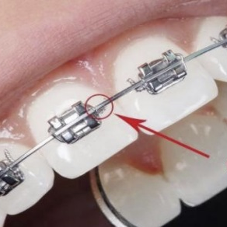 Alambre Para Ligadura Metálica  4