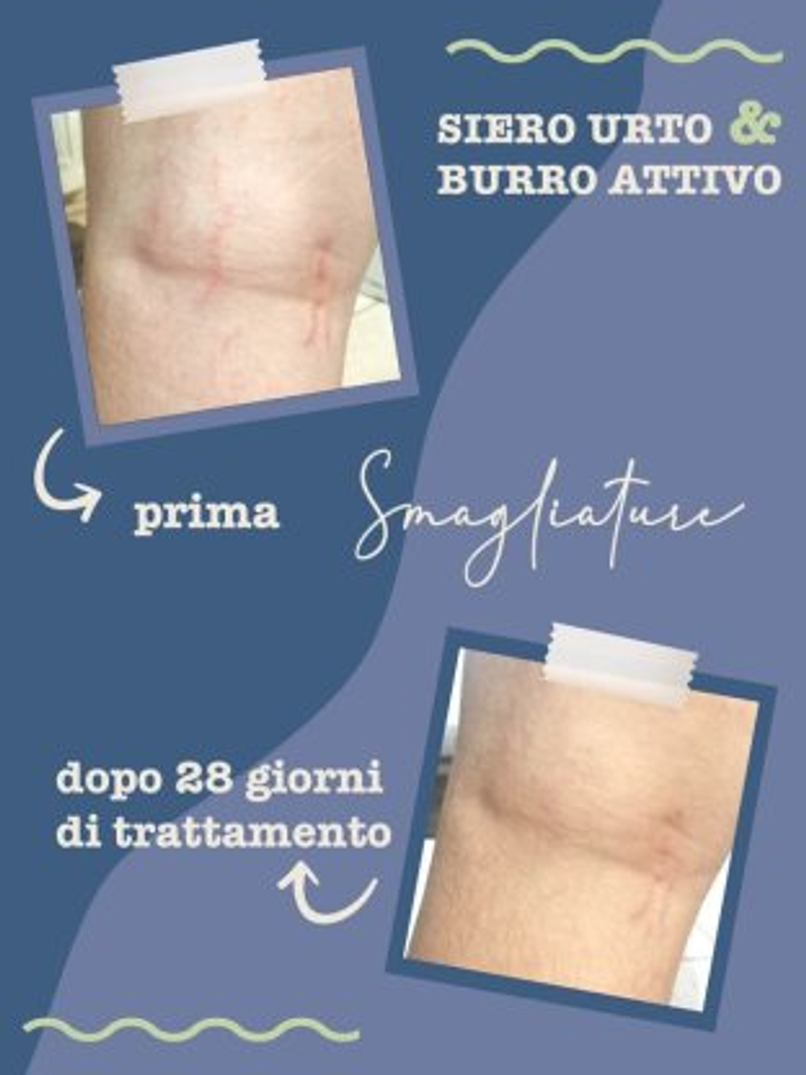 Sérum Ativo para Estrias 4