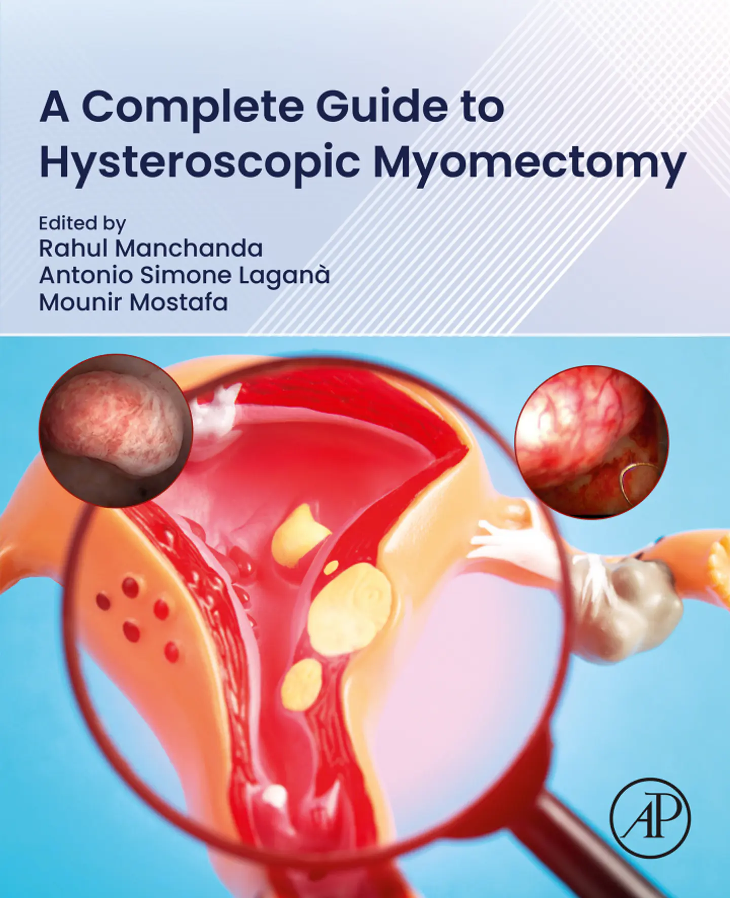A Complete Guide to Hysteroscopic Myomectomy 1