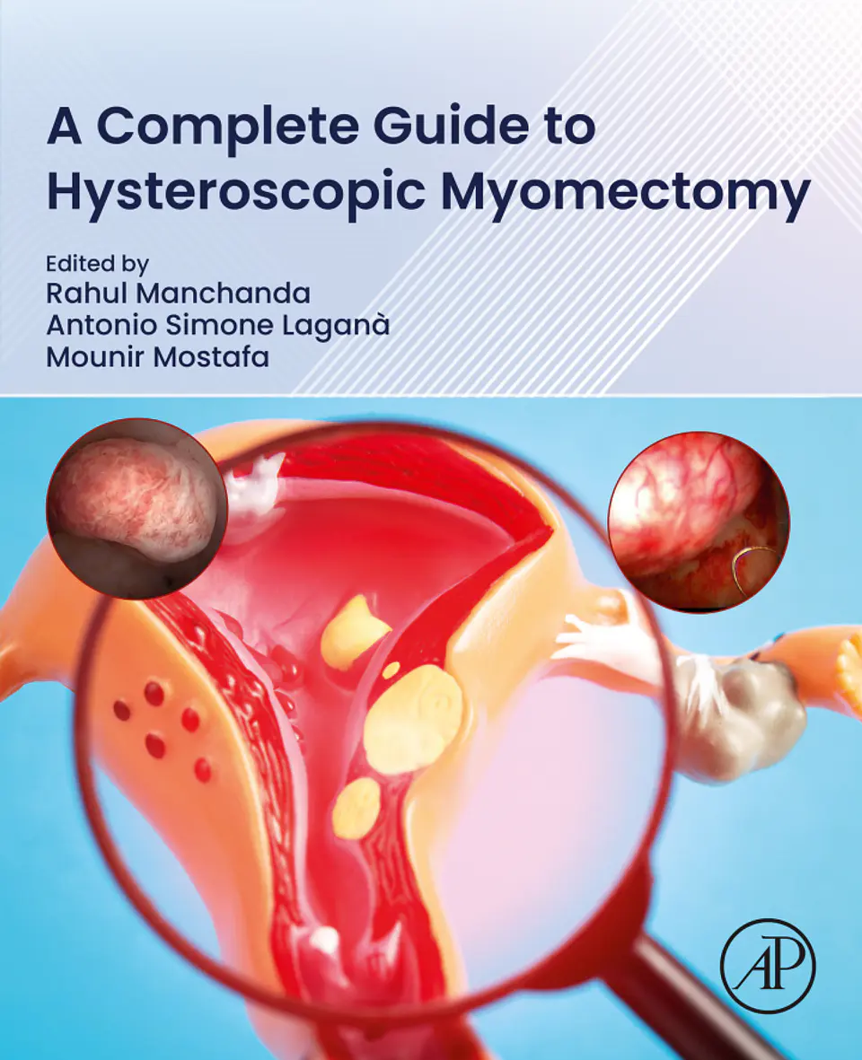 A Complete Guide to Hysteroscopic Myomectomy 1