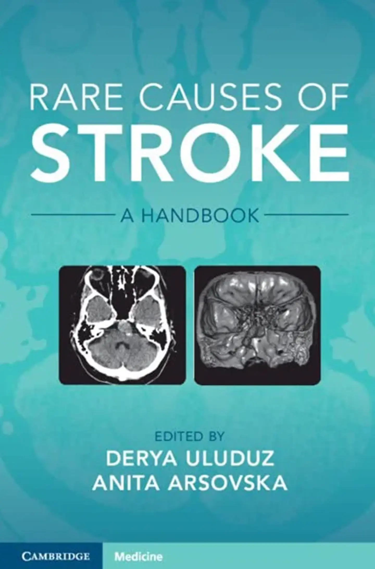 Rare Causes of Stroke: A Handbook 1