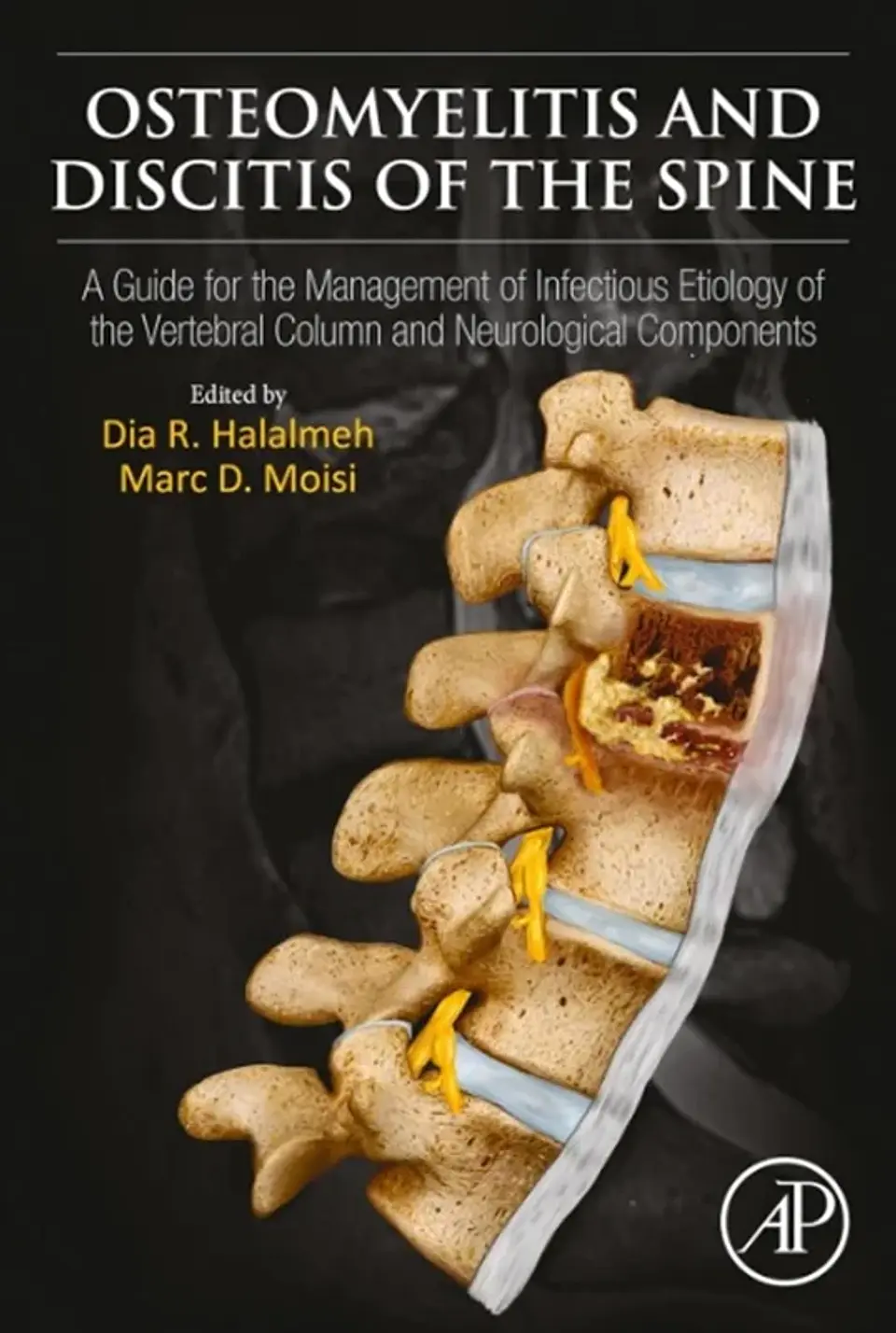 Osteomyelitis and Discitis of the Spine: A Guide for the Management of Infectious Etiology of the Vertebral Column and Neurological Components 1