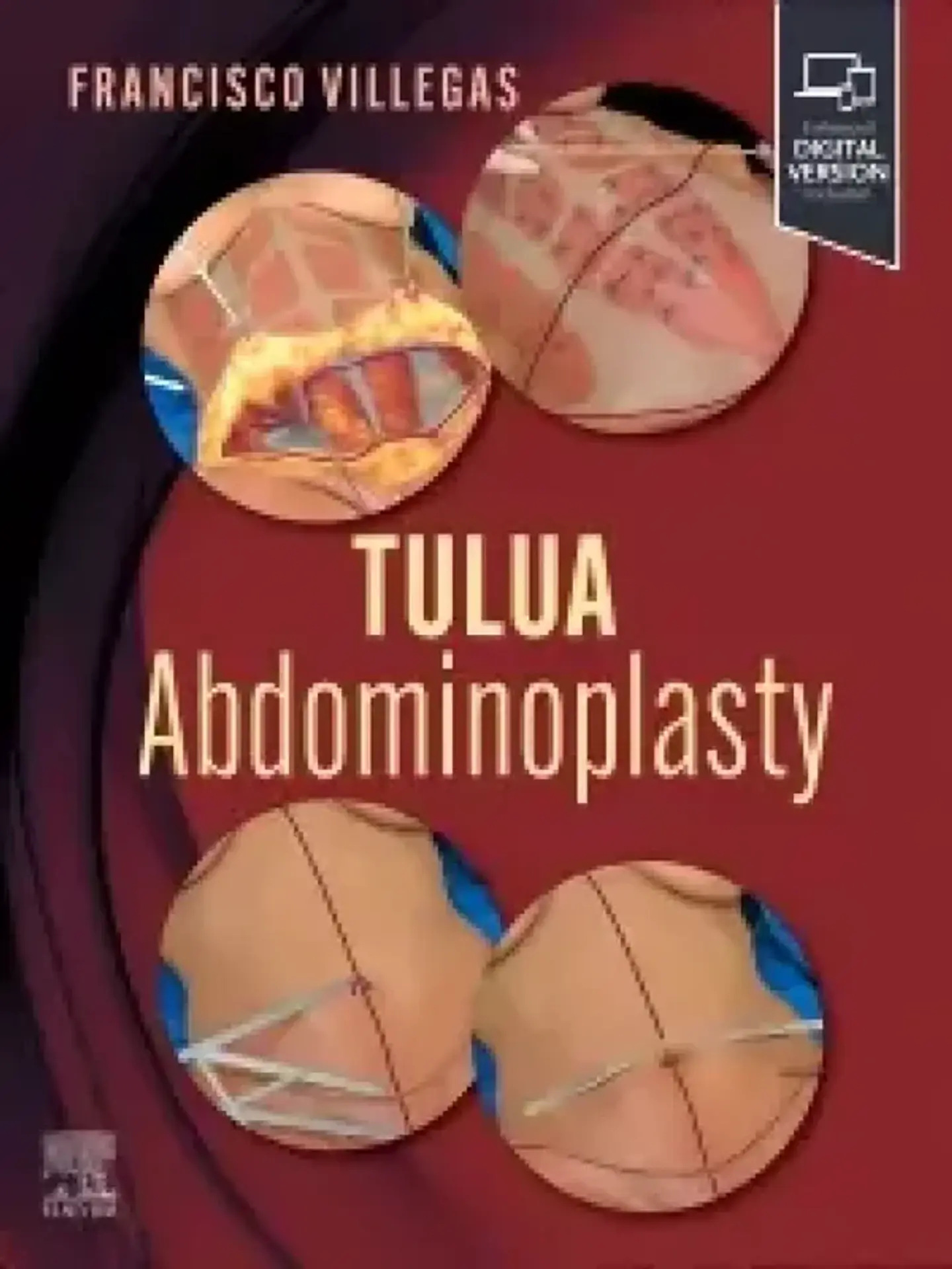 TULUA Abdominoplasty: Transverse Plication Technique 1