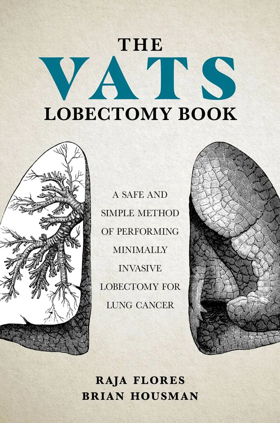 The VATS Lobectomy Book: A Safe and Simple Method of Performing Minimally Invasive Lobectomy for Lung Cancer 1