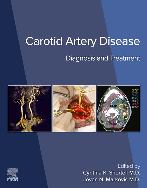 Carotid Artery Disease: Diagnosis and Treatment
