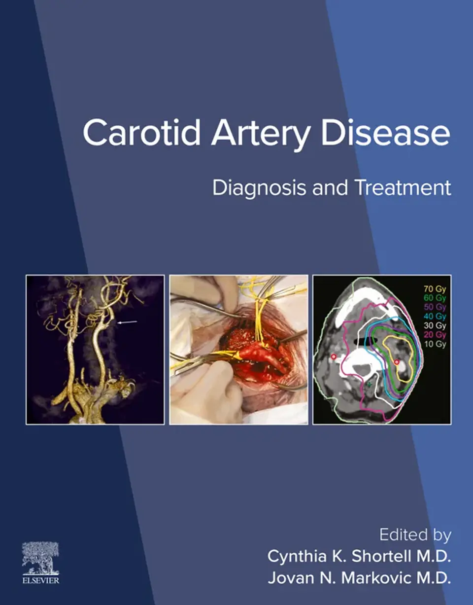 Carotid Artery Disease: Diagnosis and Treatment 1