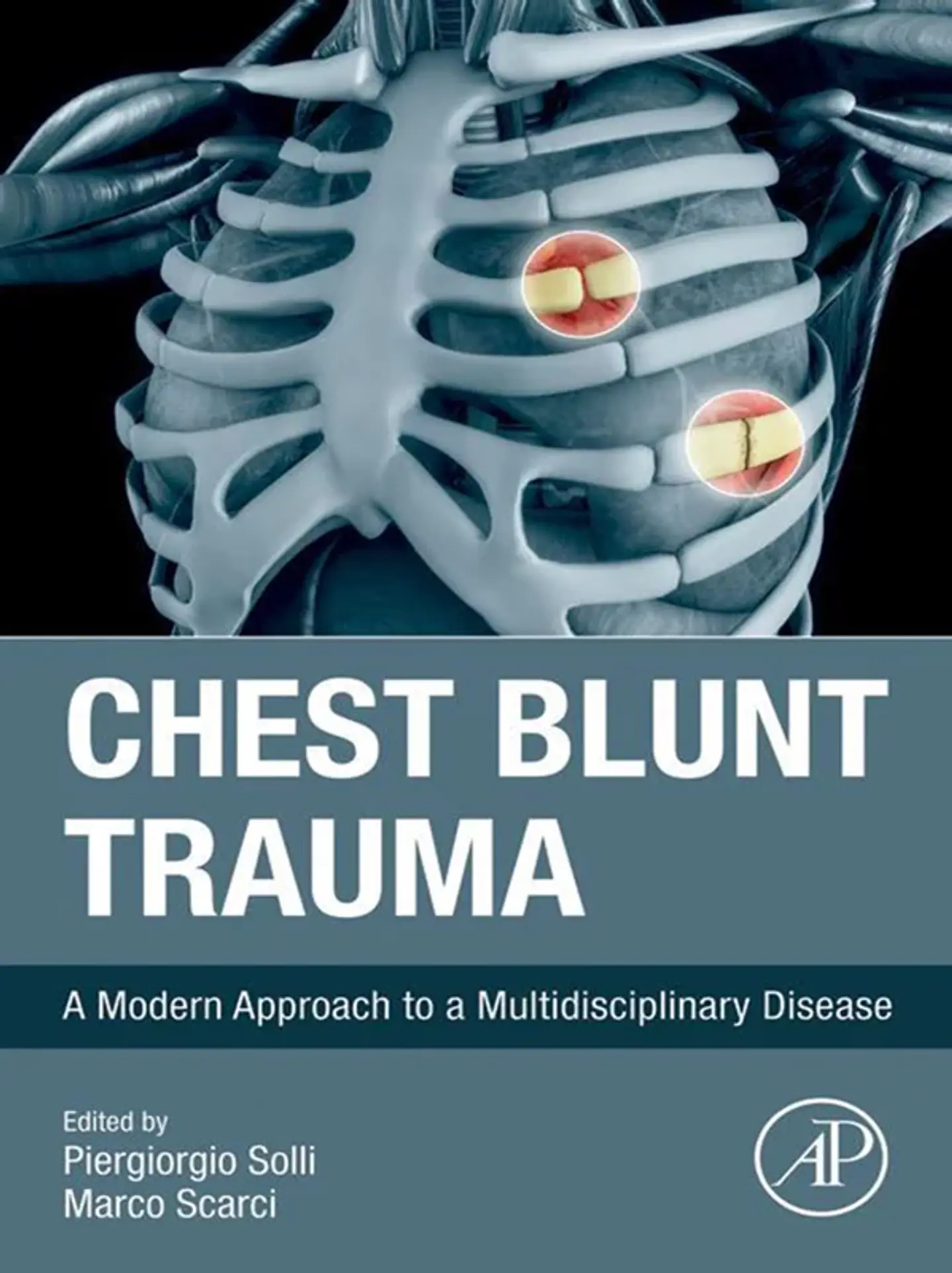 Chest Blunt Trauma: A Modern Approach to a Multidisciplinary Disease 1