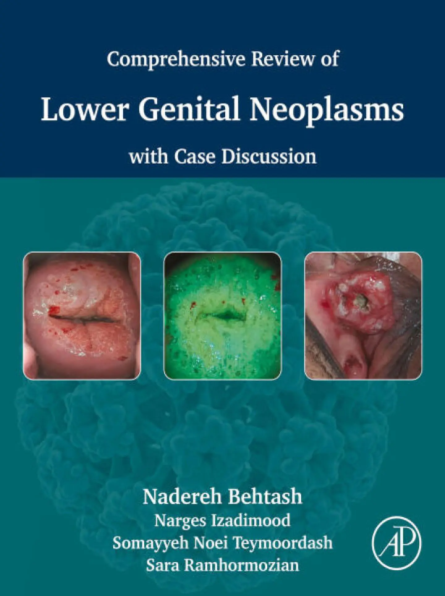Comprehensive review of lower genital neoplasms: With case discussion 1