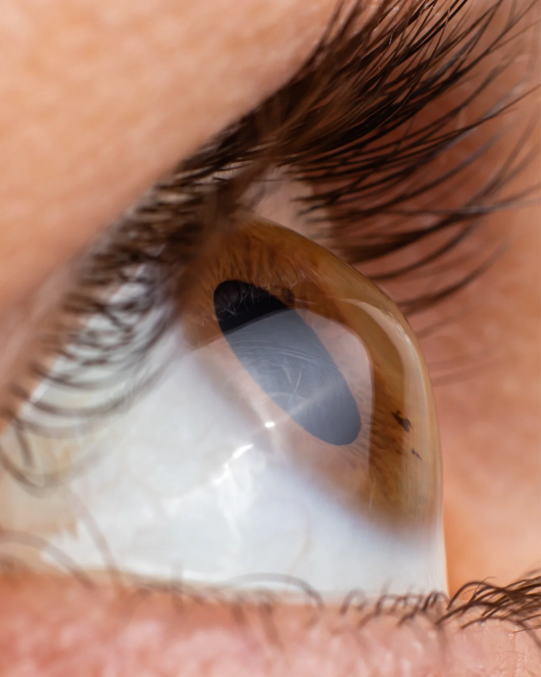¿Tienes Queratocono? La importancia de tu Topografía Corneal