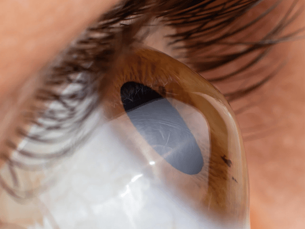 ¿Tienes Queratocono? La importancia de tu Topografía Corneal