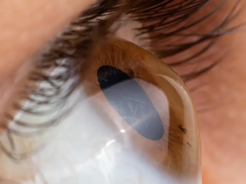 ¿Tienes Queratocono? La importancia de tu Topografía Corneal