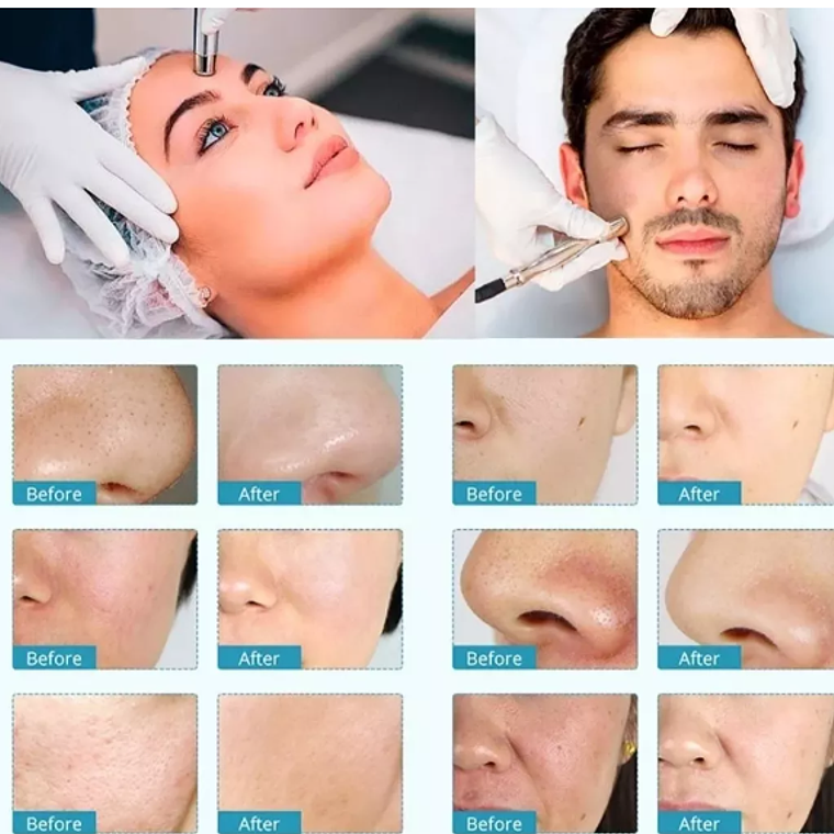 Microdermoabracion Profesional Punta De Diamante 3