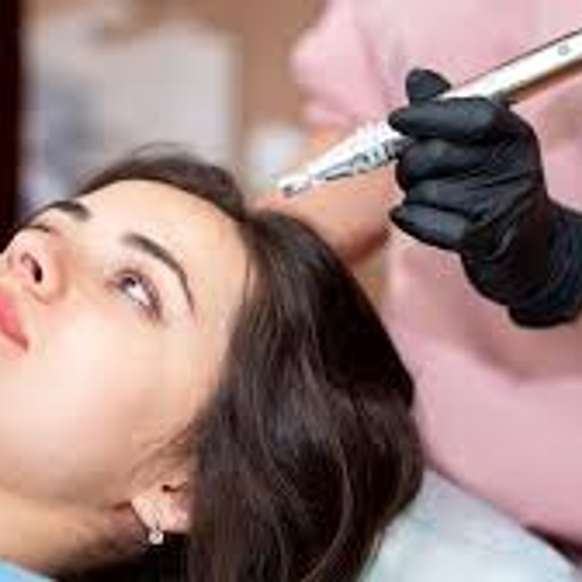 Microneedling Capilar F-Hair 1