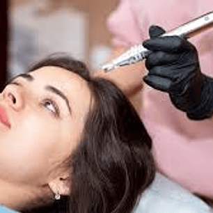Microneedling Capilar F-Hair