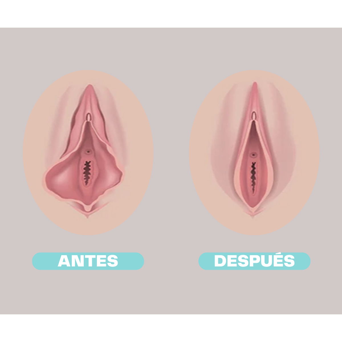 Labios Mayores Depilacion Labios Genitales Labioplastía