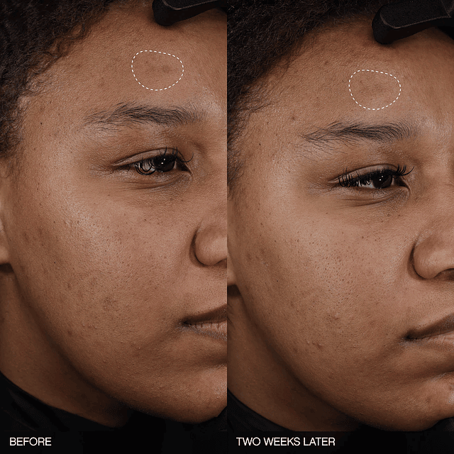 Topicals  Faded Tranexamic Acid Dark Spot Patches for Hyperpigmentation